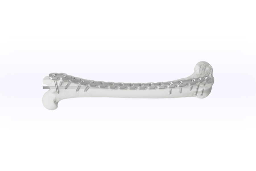 LOKI Platium Polyaxial Locking Plates