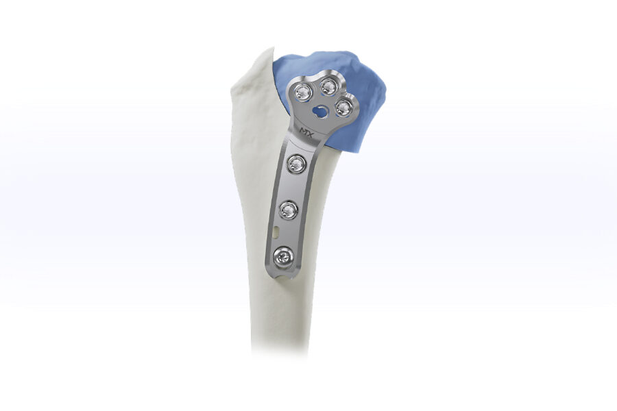 SISU Polyaxial Locking TPLO