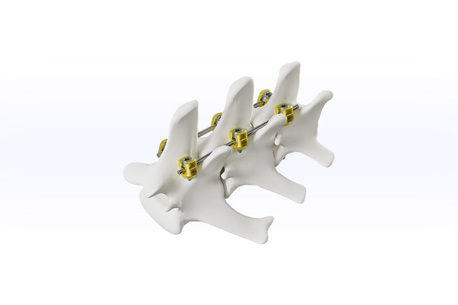 Spinal Neuro Surgery